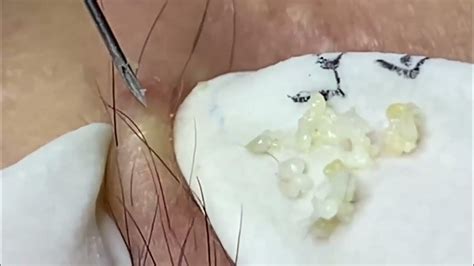 blackheads youtube|youtube enilsa brown newest video.